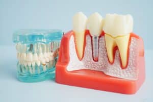 Restorative Dentistry Marlton
