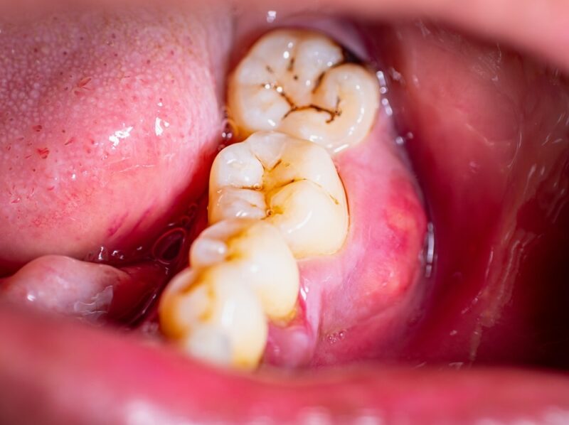 Periodontal Disease Treatment Marlton