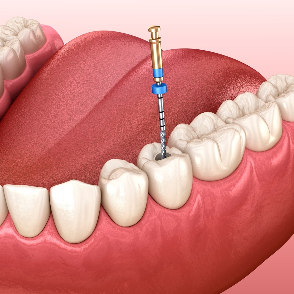 Root Canal Therapy Marlton