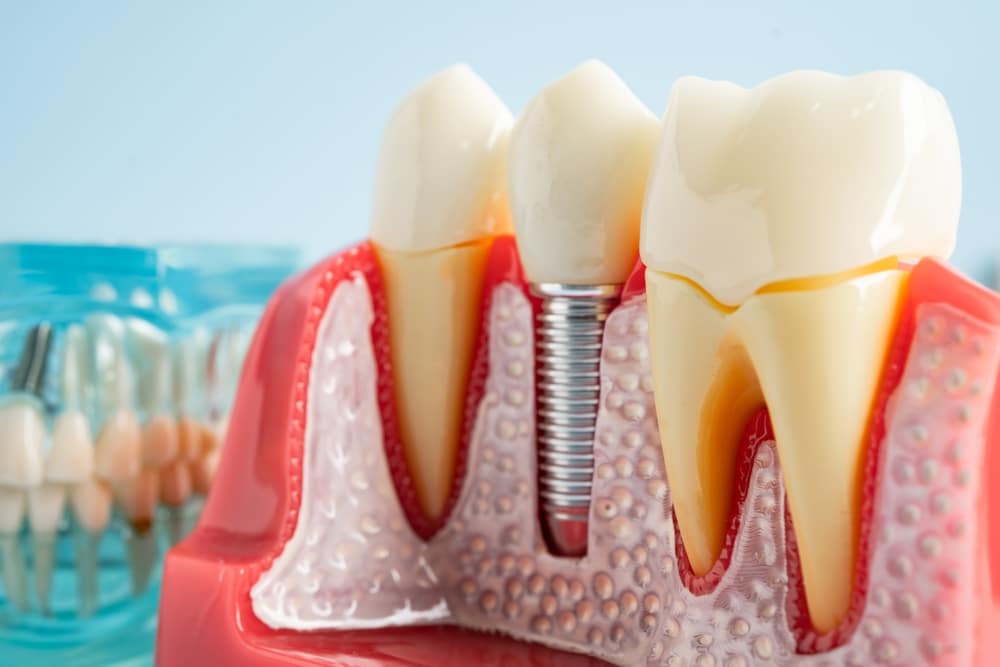 dental implants Marlton
